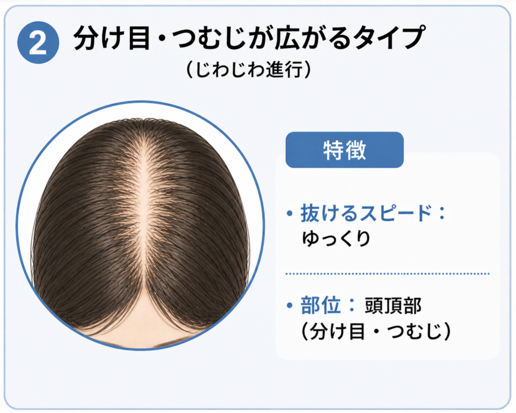 女性の薄毛 分け目・つむじが広がるタイプ